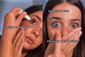 What to know about the whitening eye drops trend